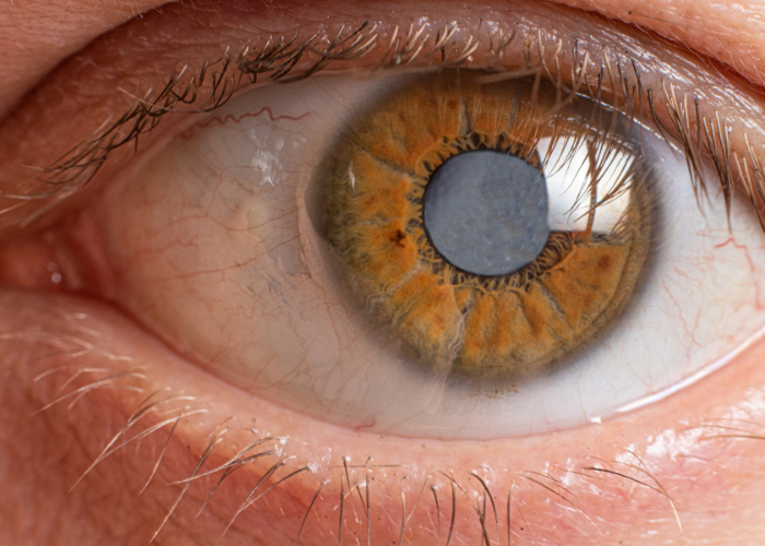 Cataract