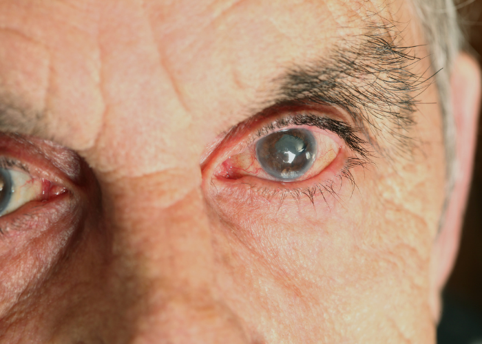 Glaucoma