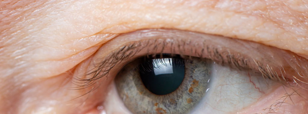 What Is Eyelid Drooping?