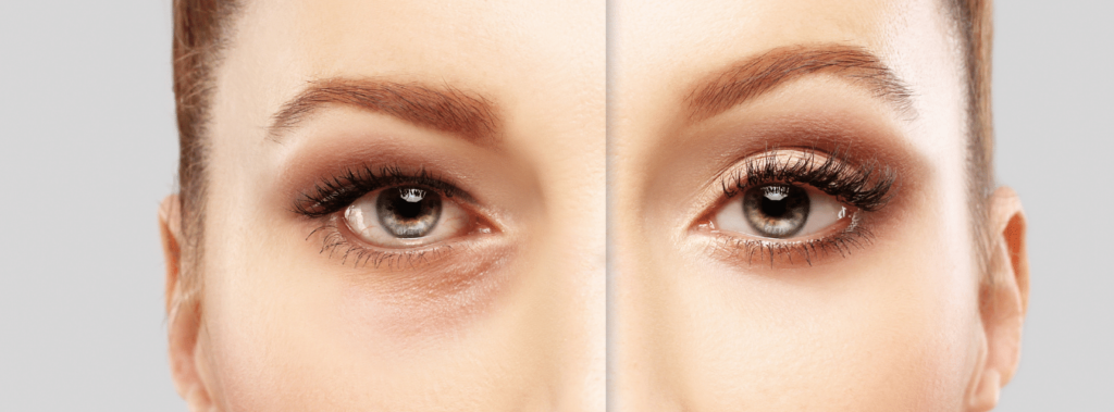 Blepharoplasty