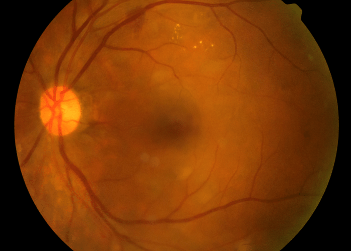 Diabetic Retinopathy
