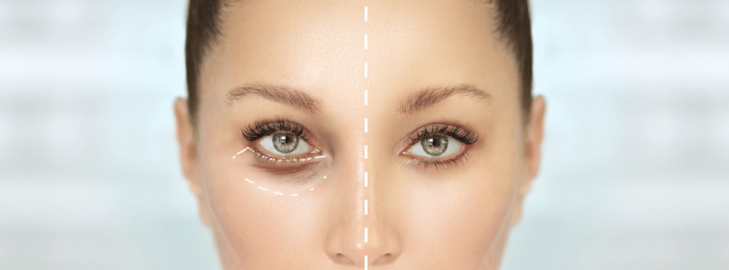 Getting Eyelid Surgery - What You Need To Know